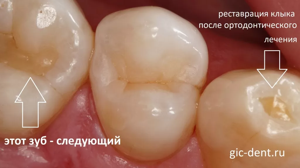 Реставрация зуба премоляра при ортодонтическом лечении. Автор работы - Меликов Азер Фуадович